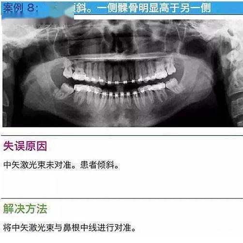 口腔全景片图解图片