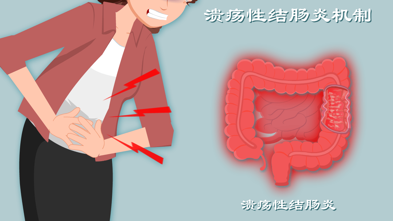 腹泻里急后重电解质紊乱还昏迷动漫揭秘溃疡性结肠炎7宗罪