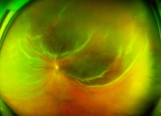 视网膜脱落闪光感图片图片