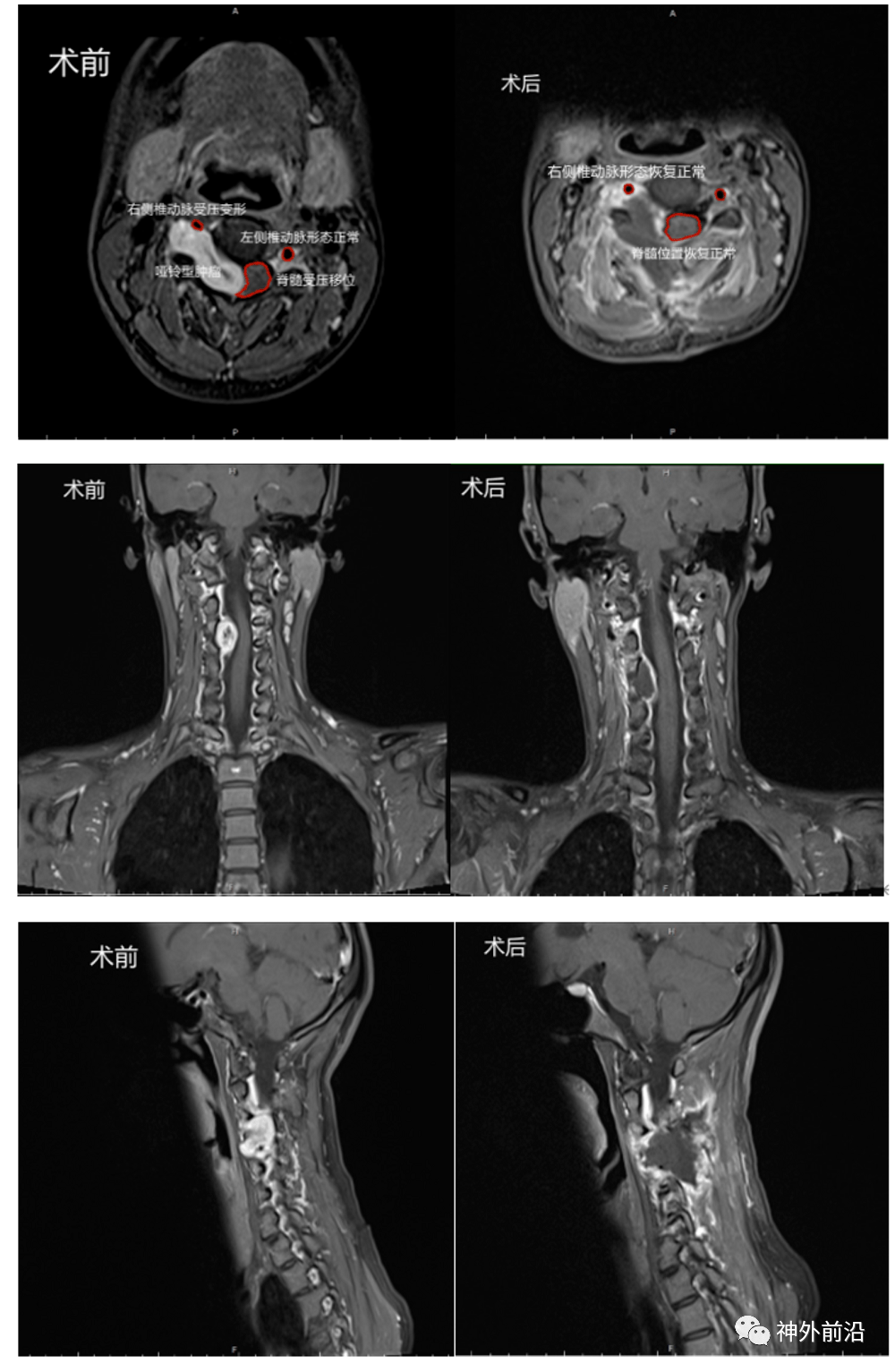内镜前沿内镜手术切除高位颈髓哑铃型肿瘤同时减少骨质破坏一例世纪坛