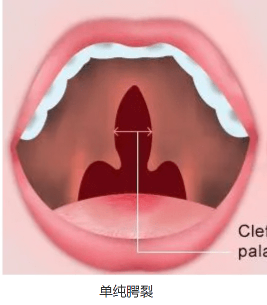 喉咙腭裂图片