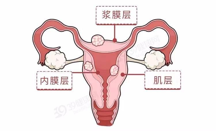 提醒女性身體有這3個症狀別死扛可能是子宮肌瘤上門了