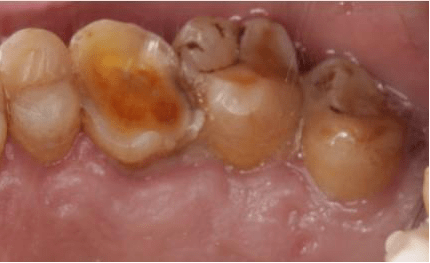 酸牙倒牙别紧张带你认识牙本质敏感症