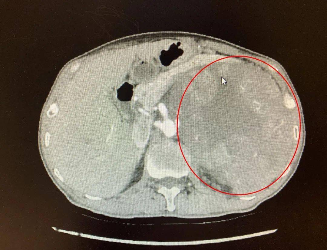 男子腰部乏力检查竟患癌肇庆一院成功切除巨型腹膜后肿瘤助其重获新生