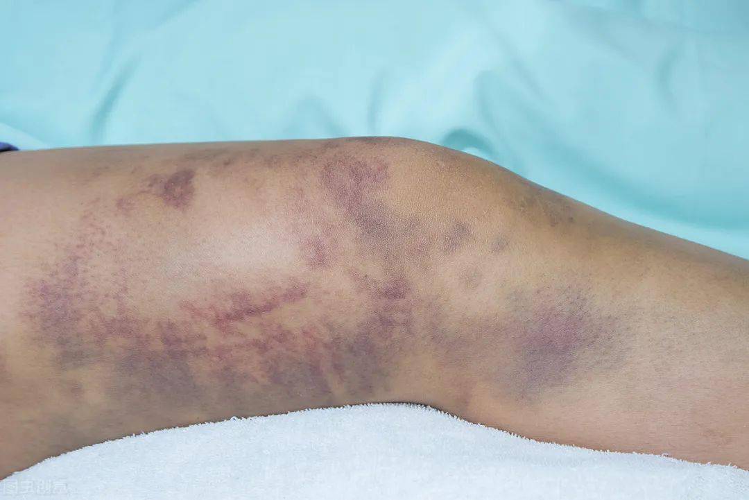 血栓来临手脚先知医生提醒手脚出现5大症状需警惕血栓