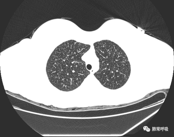 诊断需谨慎*血行播散性肺结核:均匀分布的大小,密度一致的粟粒结节2