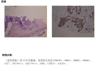 肿瘤|【医文医话】肿瘤二科为高龄患者探索肠道活检新路径