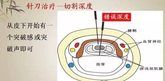 針刀治療屈指肌腱狹窄性腱鞘炎