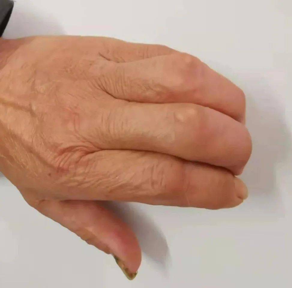 多数的风湿免疫病可有关节症状,时间可长可短,可为游走性或固定性疼痛