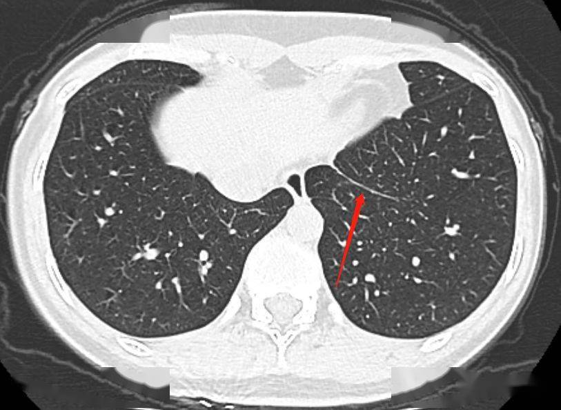 胸部ct上的