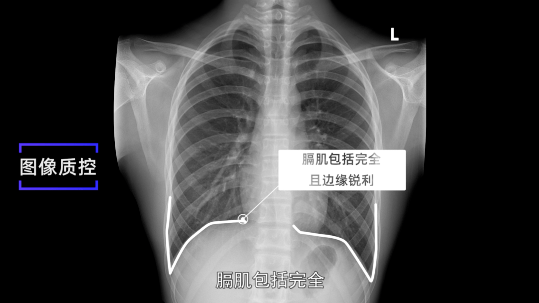 膈肌幕状粘连x线图片图片