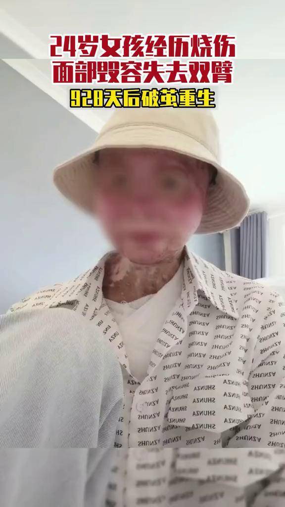 24岁女孩遭遇汽车自燃事故面部毁容失去双臂仍然朝前看客服困难乐观