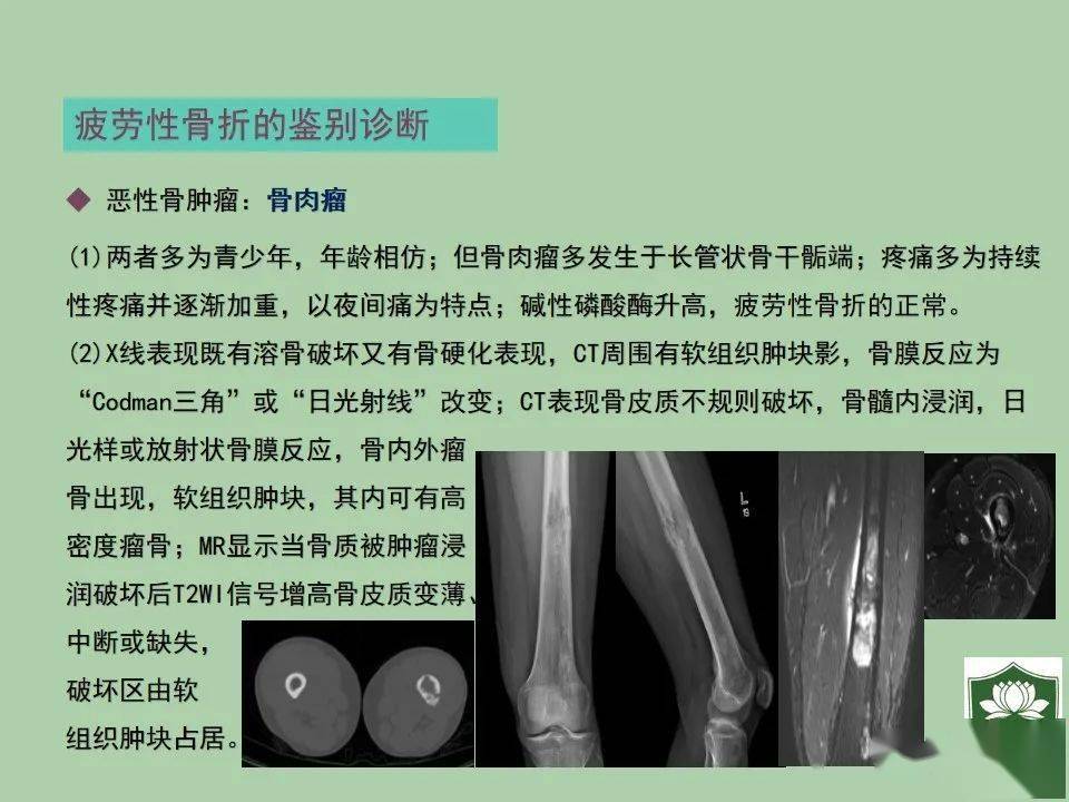 疲劳性骨折的影像诊断