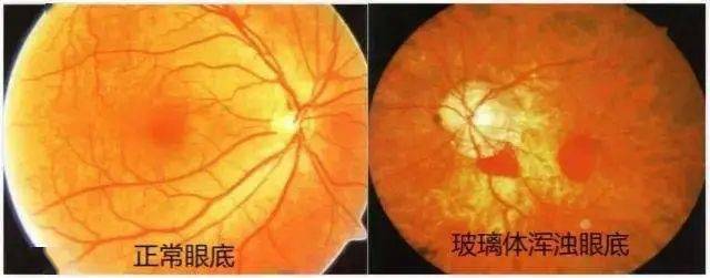 黄斑区是眼睛视觉敏感部位,当黄斑区视力细胞和色素上皮细胞退化时,会