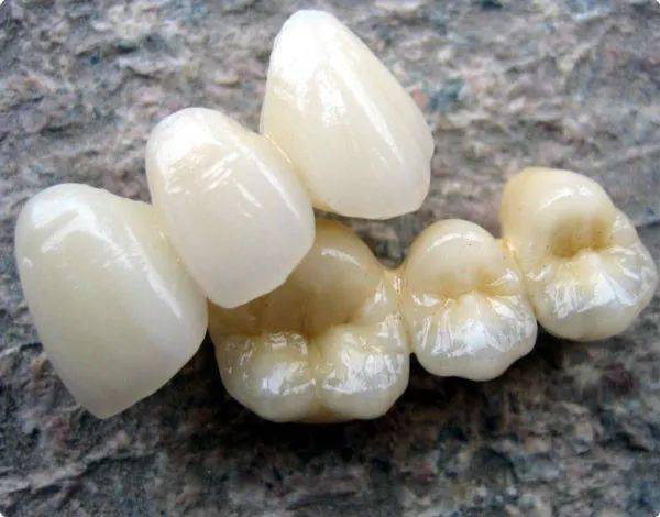 假牙大全总有款假牙适合您