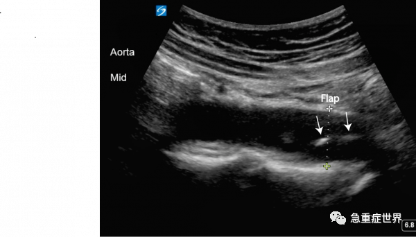 超声频道诊断b型主动脉夹层有图片有视频