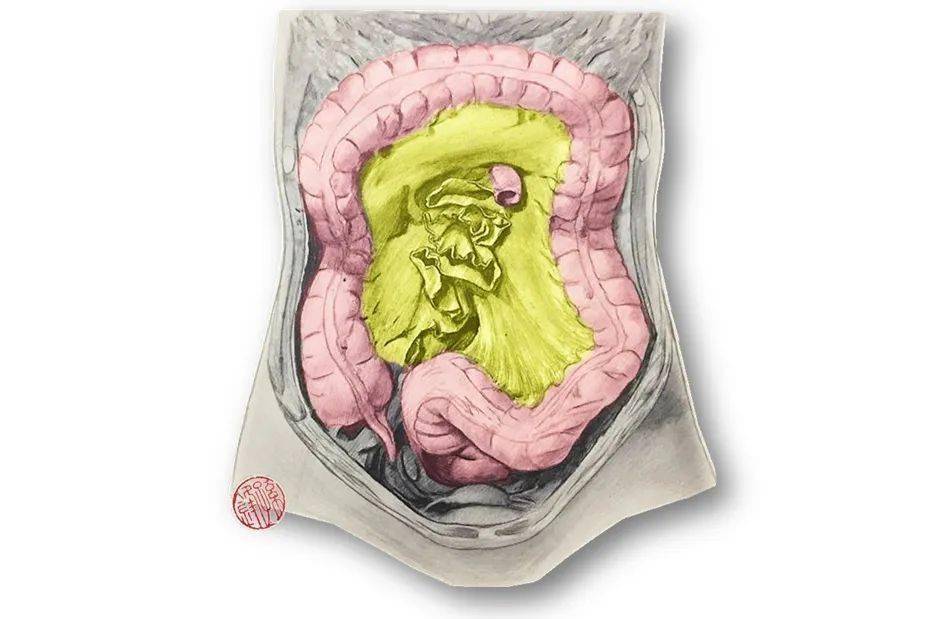 醫學課堂預防性迴腸造口術後患者進了icu