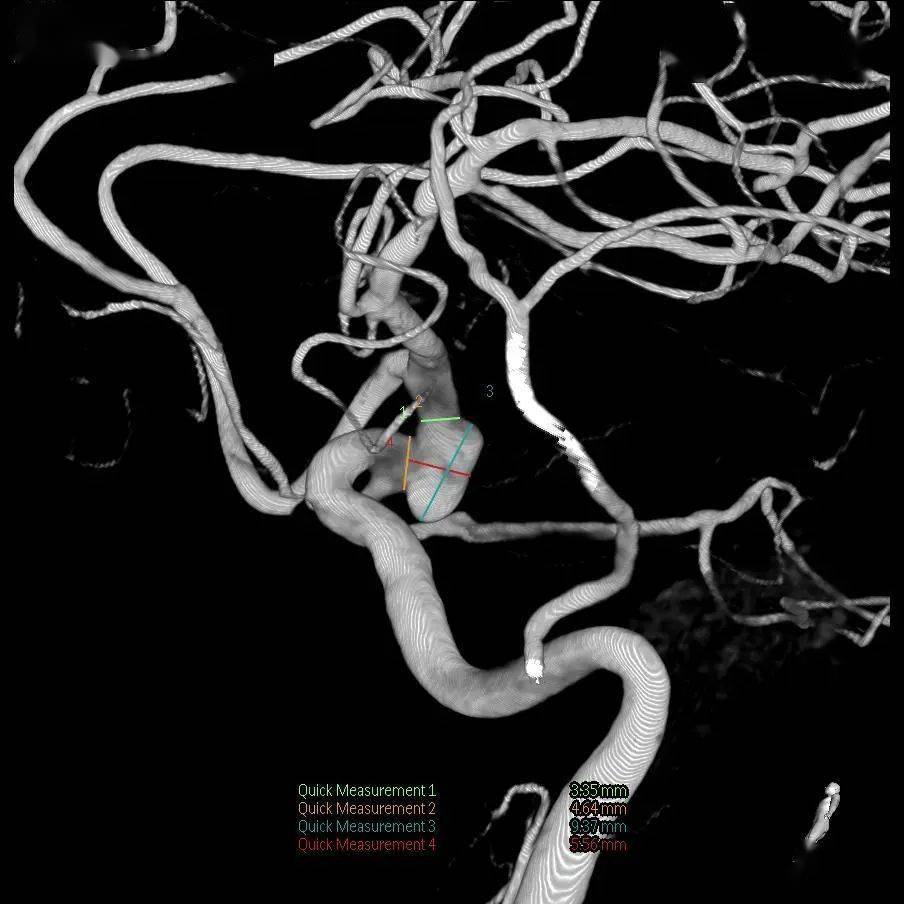 圖2動態3d dsa術前dsa:圖1術前ctacta:左側頸內動脈c7段動脈瘤,約6mm
