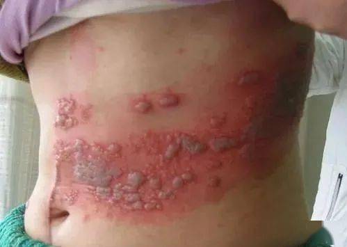 治疗蛇盘腰民间中医绝技收藏备用