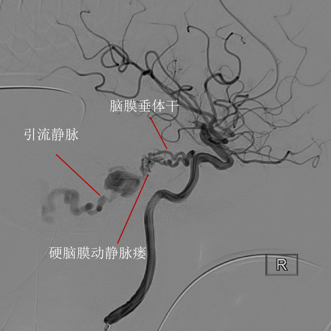 經腦膜垂體幹途徑栓塞小腦幕硬腦膜動靜脈瘻