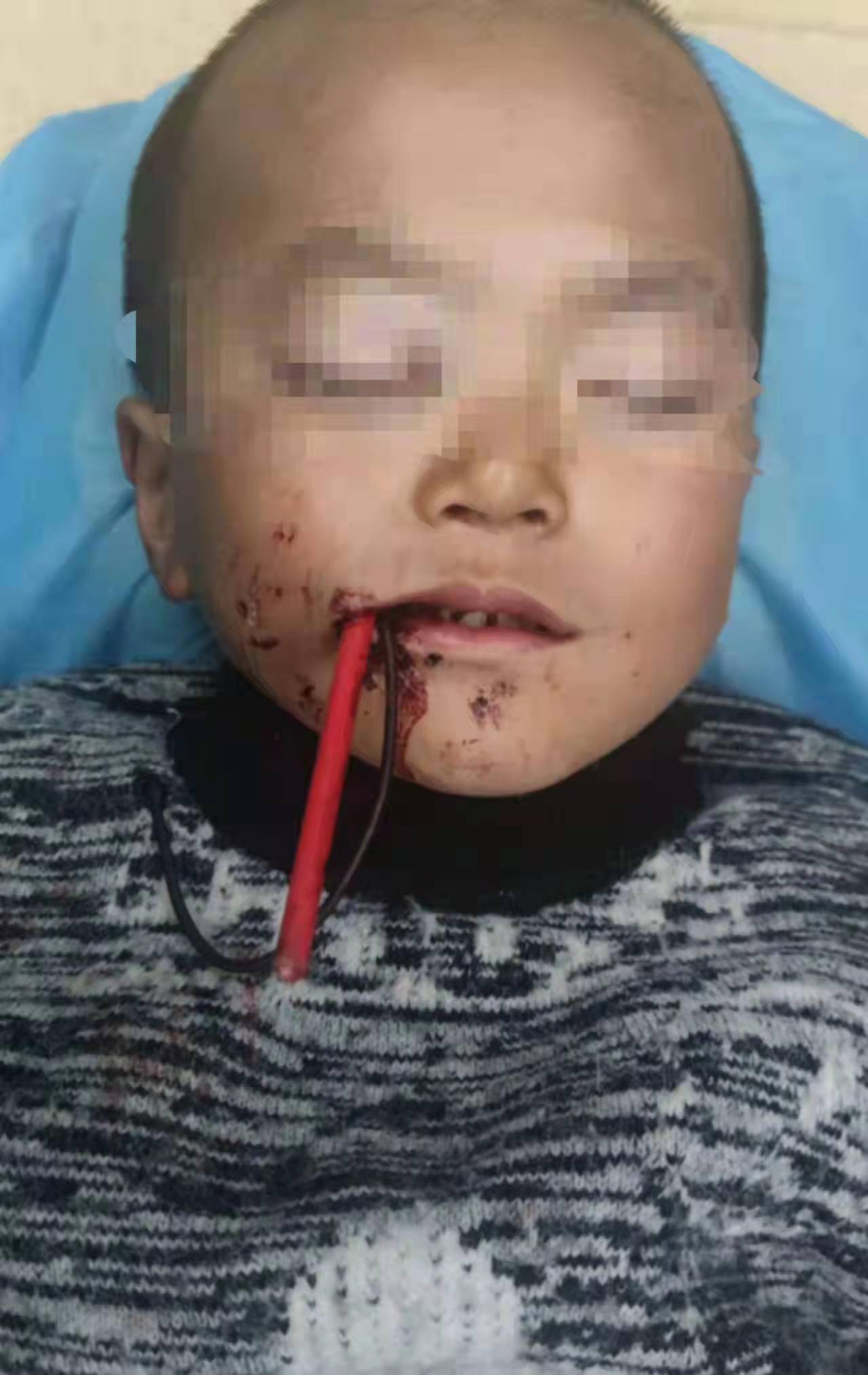 儿童玩筷子受伤图片图片
