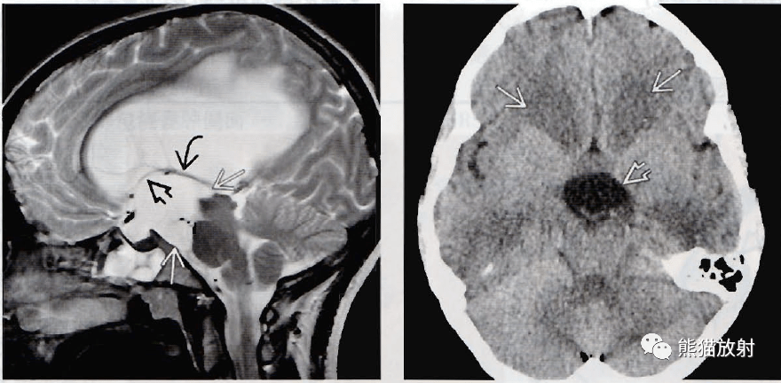 脑内囊肿图片