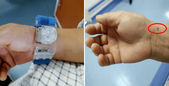 北京中医医院怀柔医院成功完成首例经桡动脉全脑血管造影术