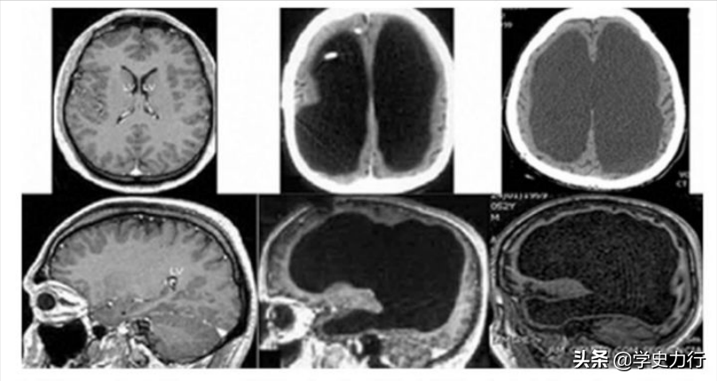 英国大学生头疼就医，医生给他脑部CT后惊呆了，他竟然没有大脑……