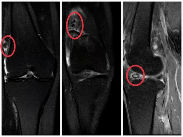 膝盖痛了好几个月,竟然是关节里藏了"老鼠"!_手术_损伤_治疗