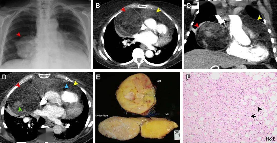 良性纵隔肿瘤图片图片