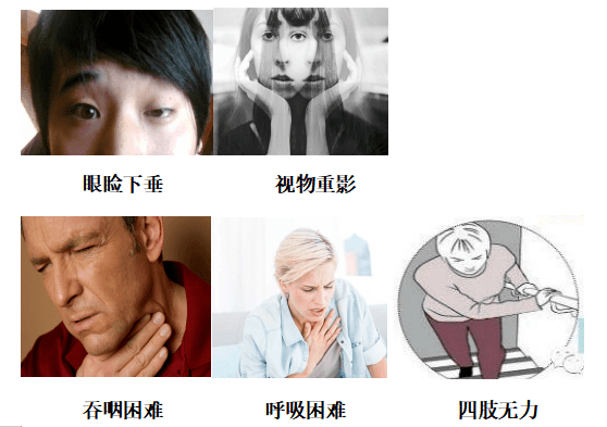 初中女生視力模糊,竟然是重症肌無力!真想不到……_情況_患者_免疫