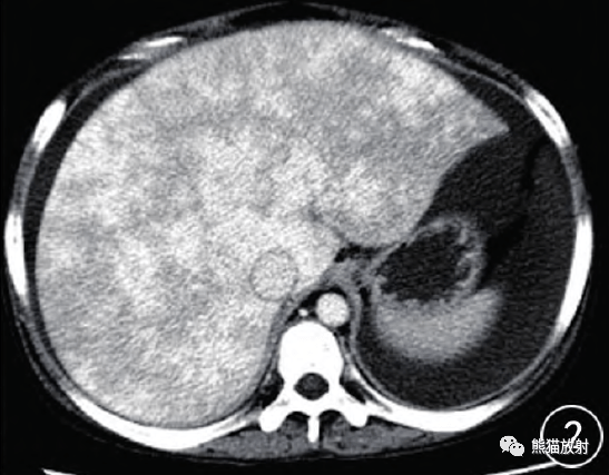 肝窦阻塞综合征丨临床,发病机制,影像学表现_静脉_肝脏_区域