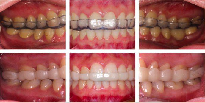 总是半夜磨牙,究竟是为什么?_咬合_牙齿_磨损