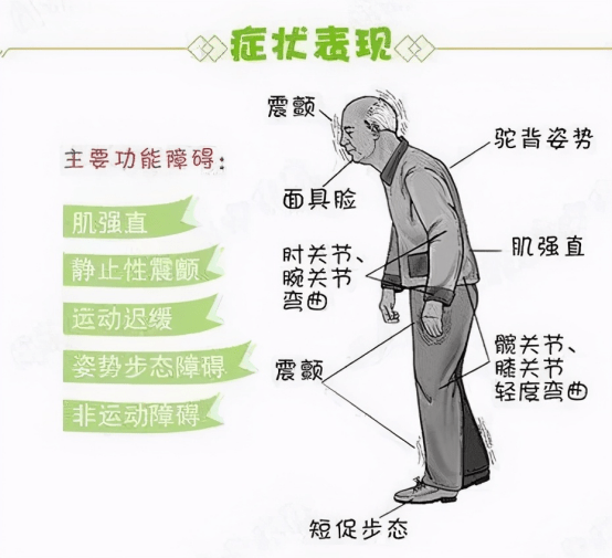 帕金森病是老年人中常见的一种神经系统退行性疾病,临床表现为静止性