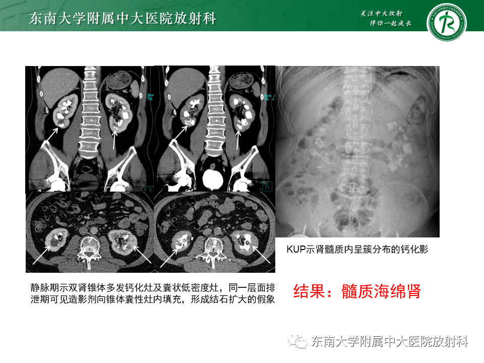 海绵肾影像图片