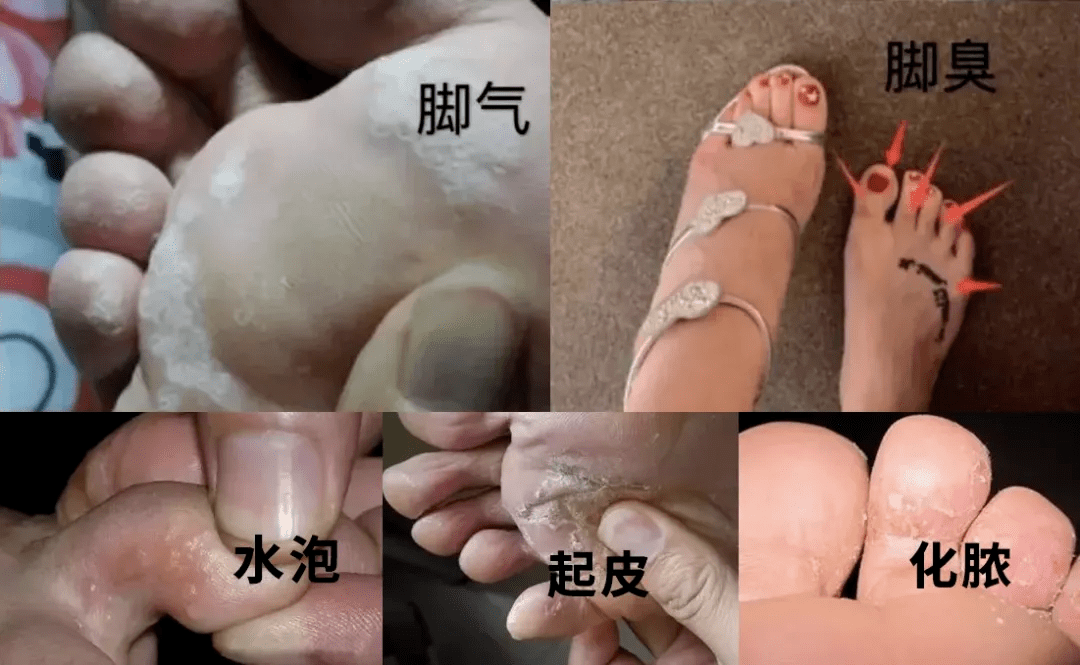 夏季的脚到底能有多臭