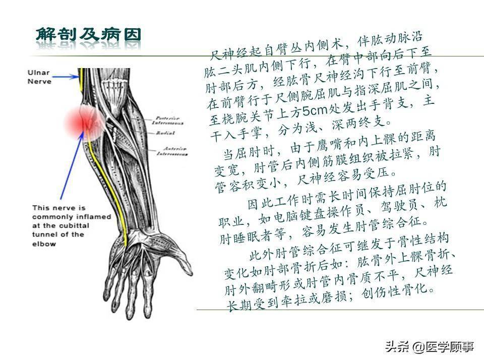 肘管綜合徵