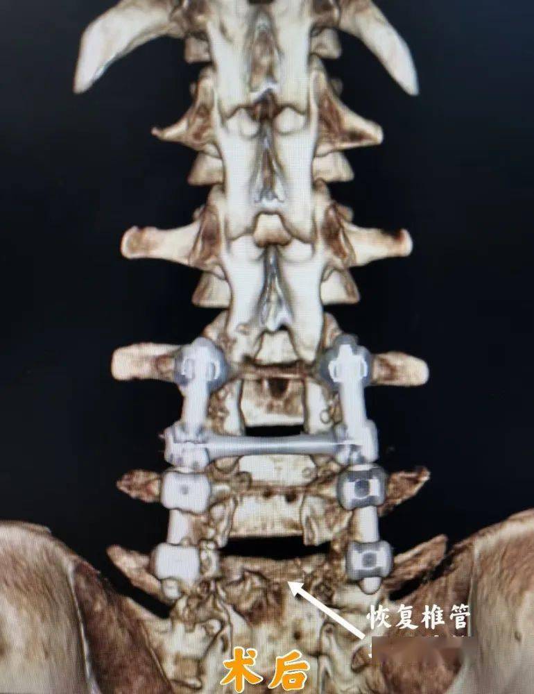 常合并其它畸形,主要为脊髓纵裂及脊柱裂,脊髓栓系,皮毛窦,脊柱侧弯等
