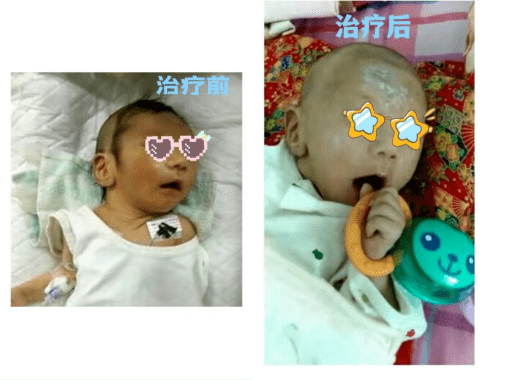 当出现反复代谢性酸中毒,肝肾功能损害及贫血等,血筛提示丙酰基肉碱升
