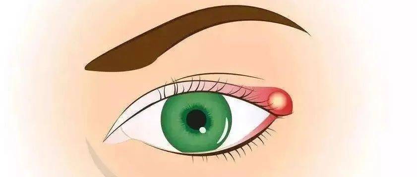 看了不该看的东西，真的会长针眼吗？_麦粒肿_症状_眼睑
