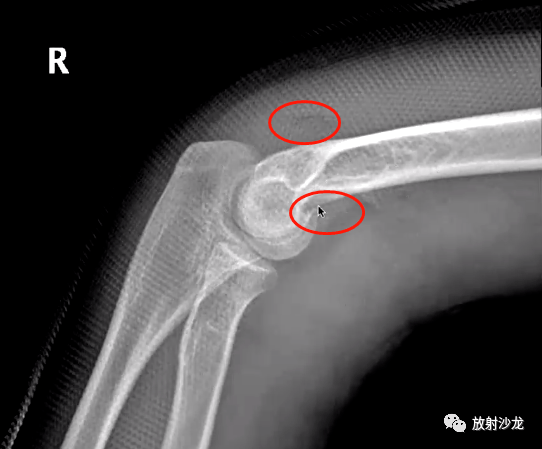 肘关节隐性创伤骨折牢记这些影像诊断重点难点高清干货