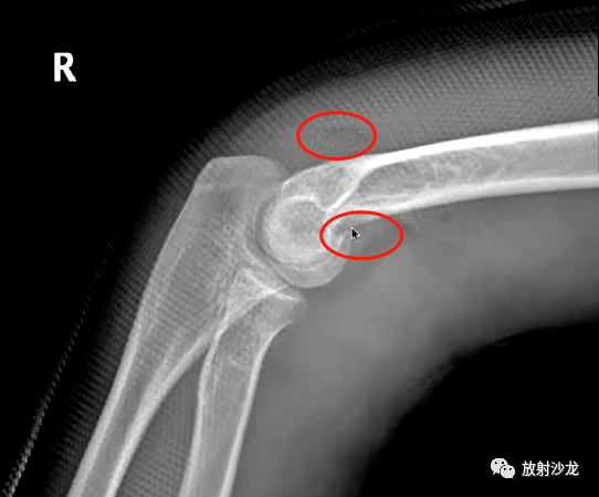 肘關節隱性創傷骨折牢記這些影像診斷重點難點高清乾貨