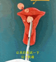 别人家的子宫肌瘤长啥样看医生如何咔咔切除