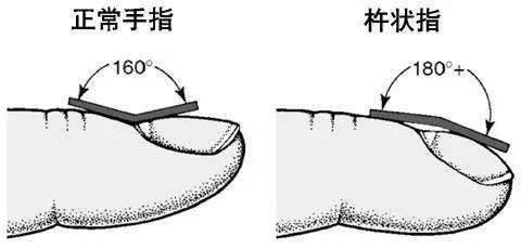 如何自测是否存在杵状指?76