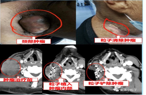 小粒子,大作為丨放射性粒子植入治療,中晚期腫瘤治療