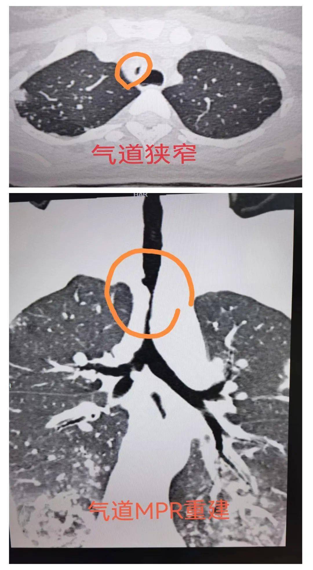 考虑到呼吸困难主要原因是气道狭窄,同时这也是首先要解决的问题.