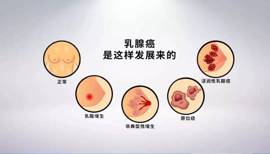 乳腺疾病的发展过程图图片