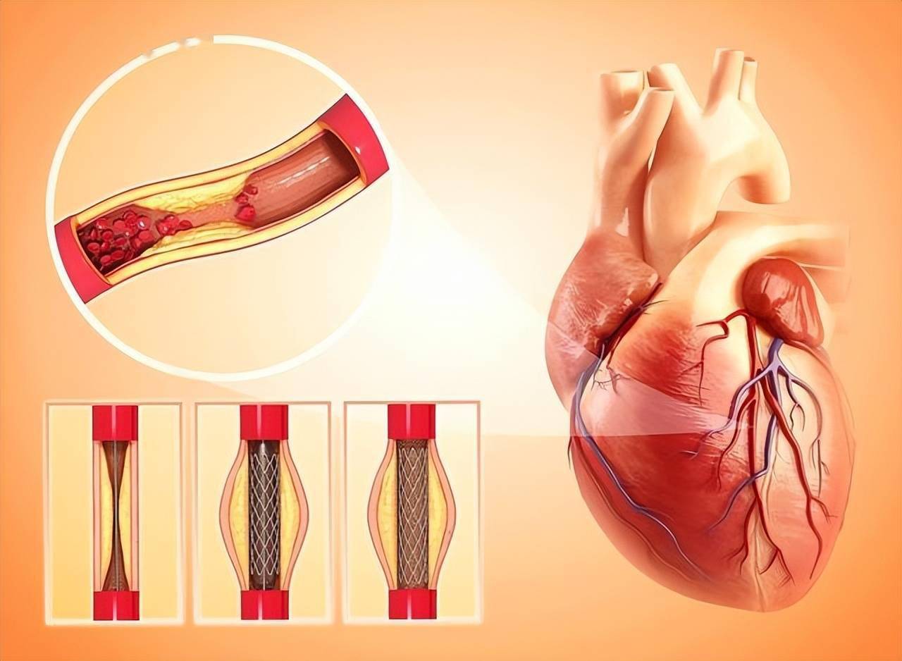 心脏支架装上会对人体有影响吗?你是如何定义支架的用处呢?