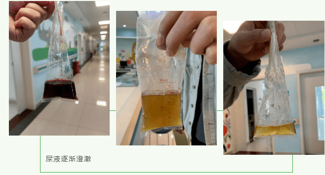 东莞凤岗2岁男童竟尿出"酱油色",全身蜡黄,立即住院治疗!