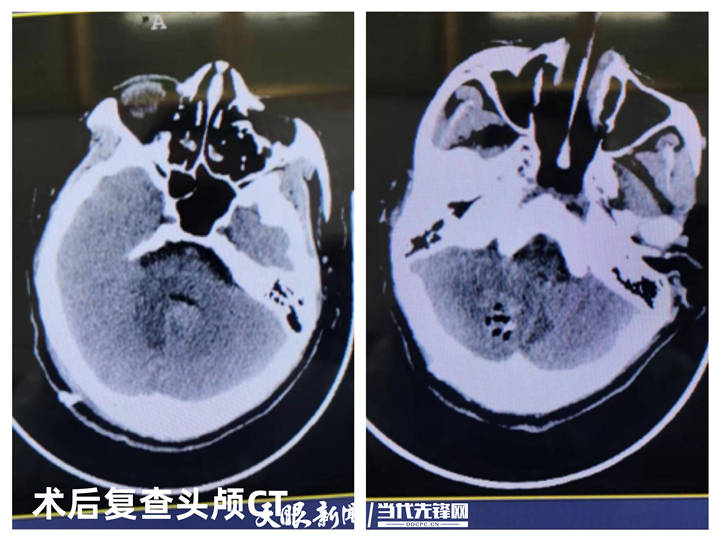 黄平县首例后颅窝开颅右侧小脑半球血肿清除术手术成功